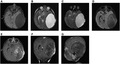 Aggressive angiomyxoma: The first case report in skull